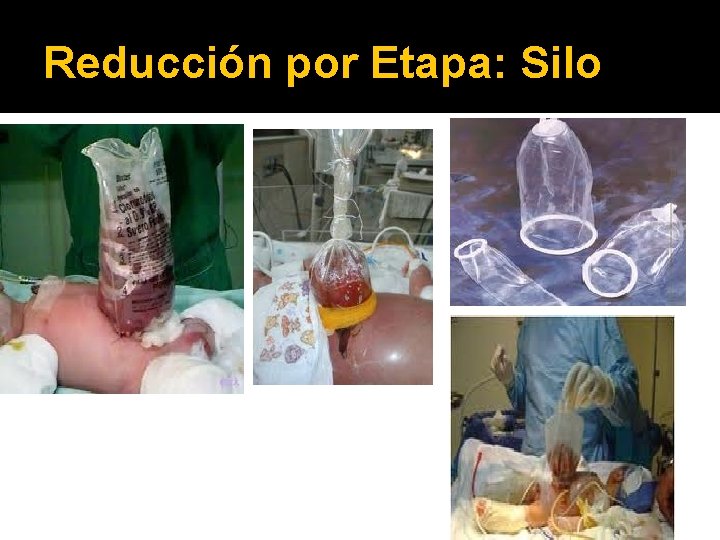 Reducción por Etapa: Silo 