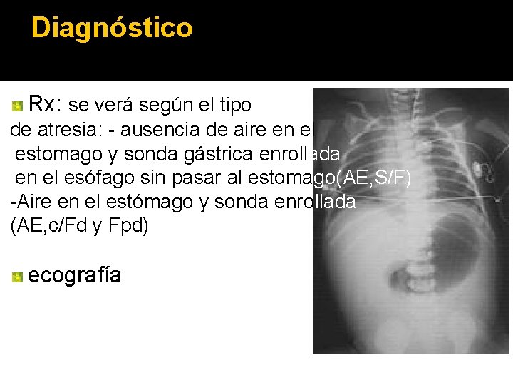 Diagnóstico Rx: se verá según el tipo de atresia: - ausencia de aire en