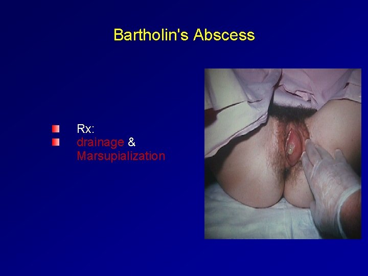 Bartholin's Abscess Rx: drainage & Marsupialization 