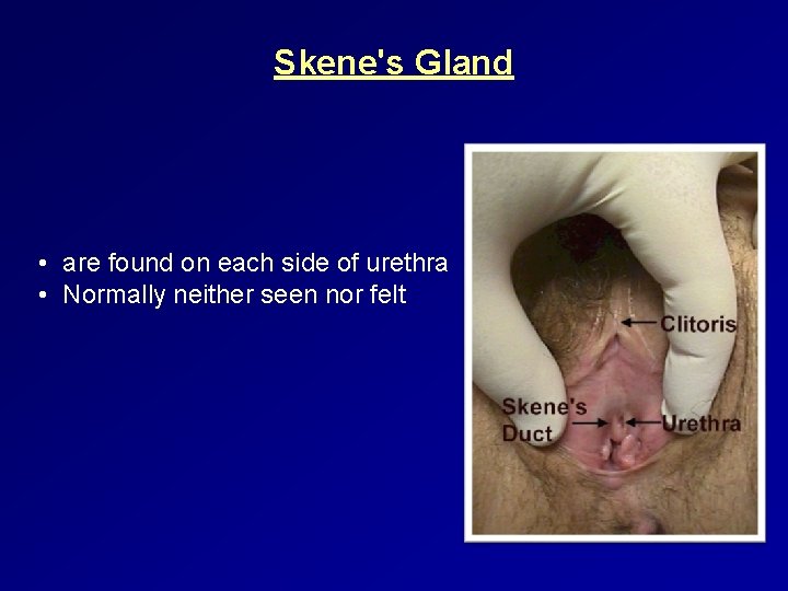Skene's Gland • are found on each side of urethra • Normally neither seen
