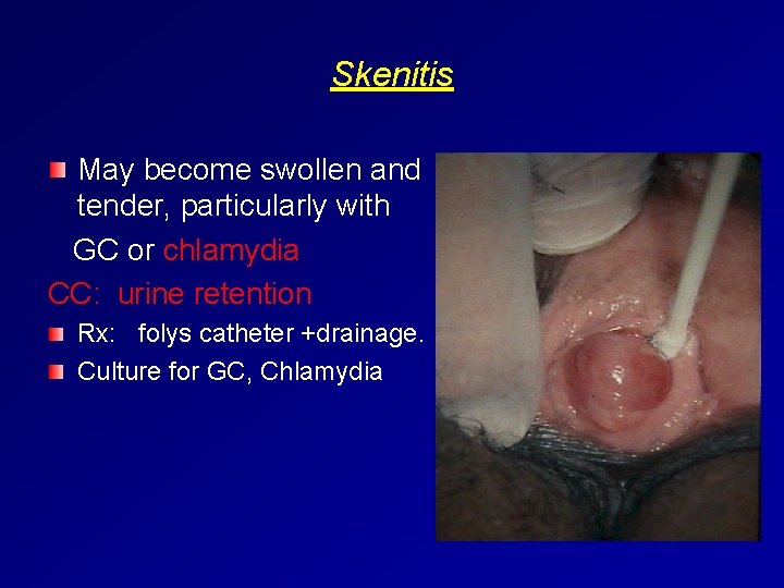 Skenitis May become swollen and tender, particularly with GC or chlamydia CC: urine retention