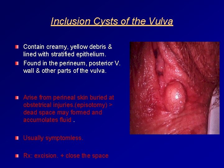 Inclusion Cysts of the Vulva Contain creamy, yellow debris & lined with stratified epithelium.