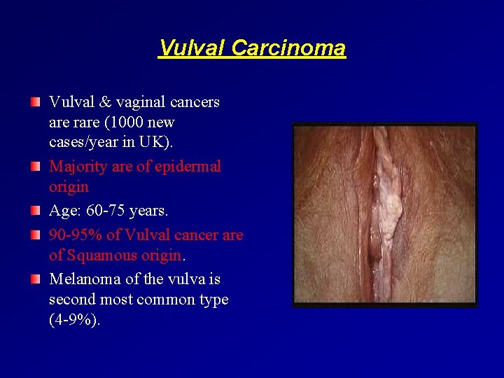 Vulval Carcinoma Vulval & vaginal cancers are rare (1000 new cases/year in UK). Majority