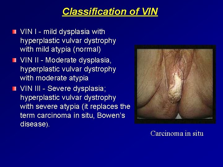 Classification of VIN I - mild dysplasia with hyperplastic vulvar dystrophy with mild atypia