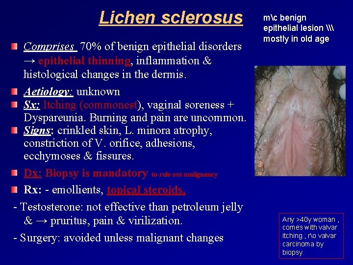 Lichen sclerosus Comprises 70% of benign epithelial disorders → epithelial thinning, inflammation & histological