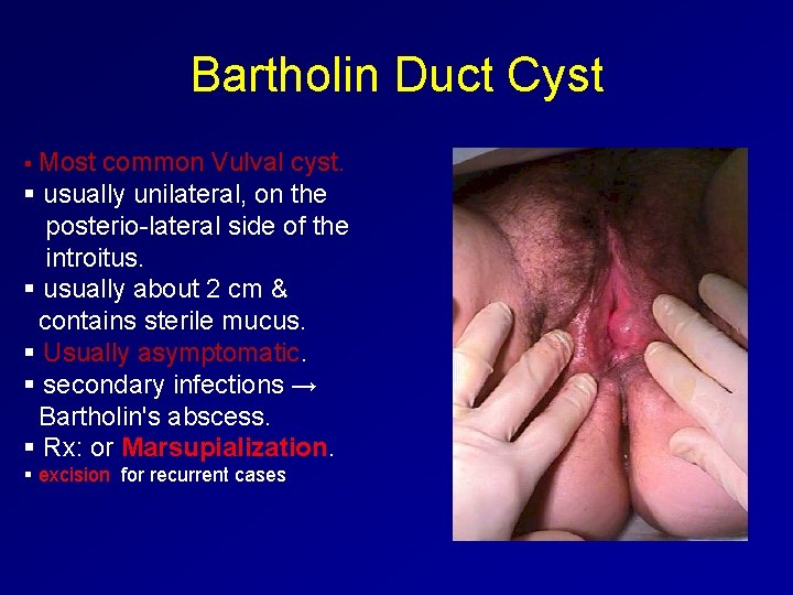 Bartholin Duct Cyst § Most common Vulval cyst. § usually unilateral, on the posterio-lateral