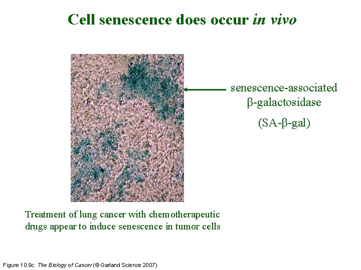 Cell senescence does occur in vivo senescence-associated β-galactosidase (SA-β-gal) Treatment of lung cancer with