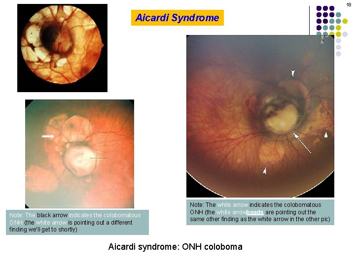 18 Aicardi Syndrome Note: The black arrow indicates the colobomatous ONH (the white arrow