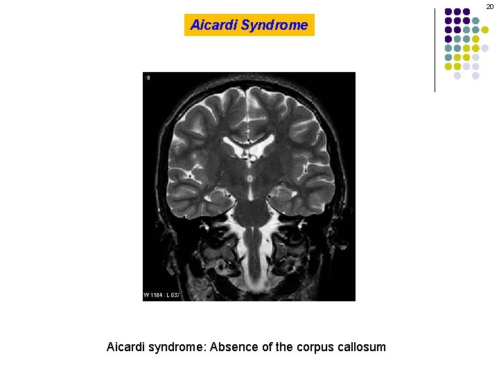 20 Aicardi Syndrome Aicardi syndrome: Absence of the corpus callosum 