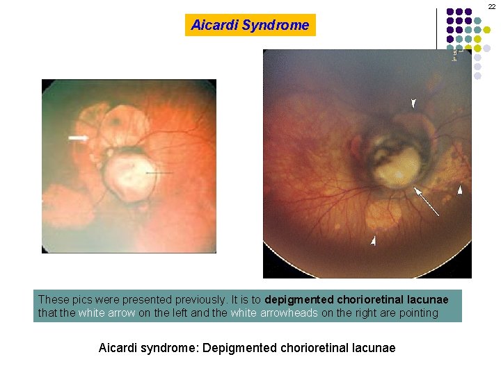 22 Aicardi Syndrome These pics were presented previously. It is to depigmented chorioretinal lacunae