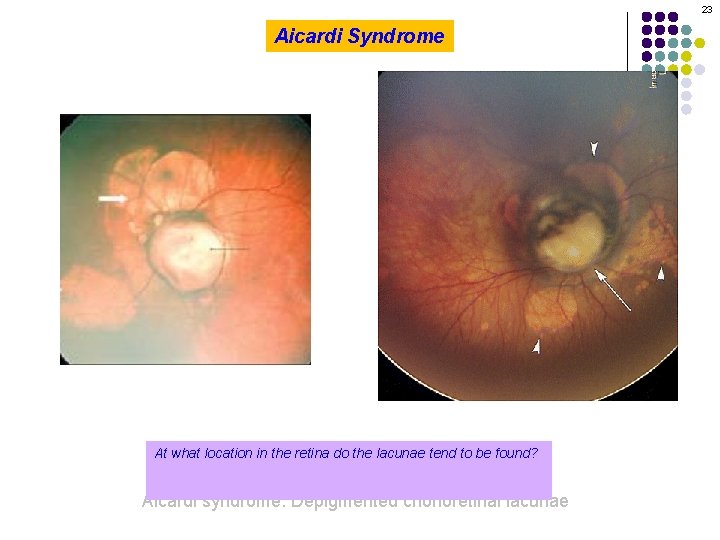 23 Aicardi Syndrome At what location in the retina do the lacunae tend to