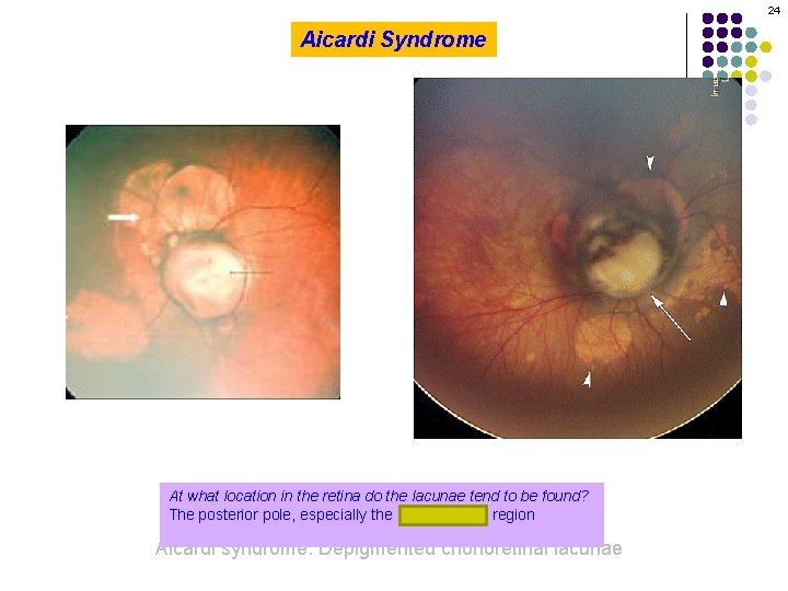 24 Aicardi Syndrome At what location in the retina do the lacunae tend to