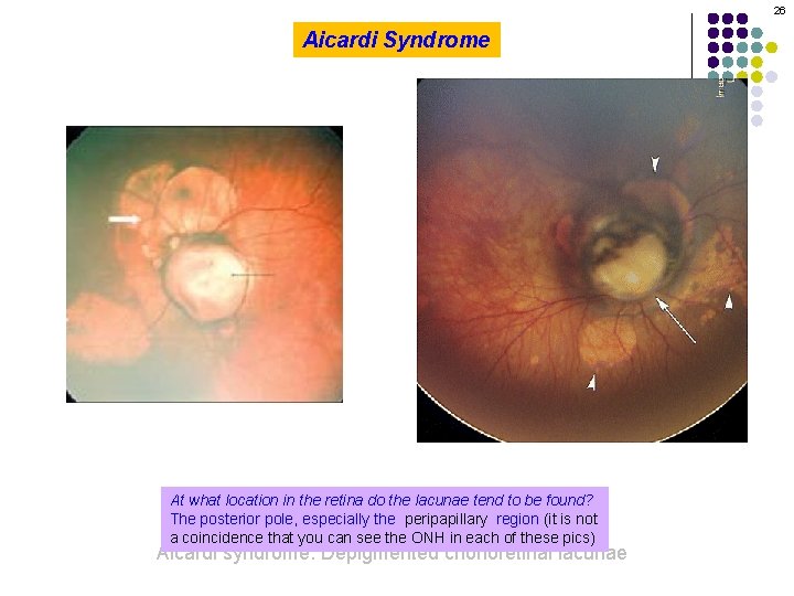 26 Aicardi Syndrome At what location in the retina do the lacunae tend to