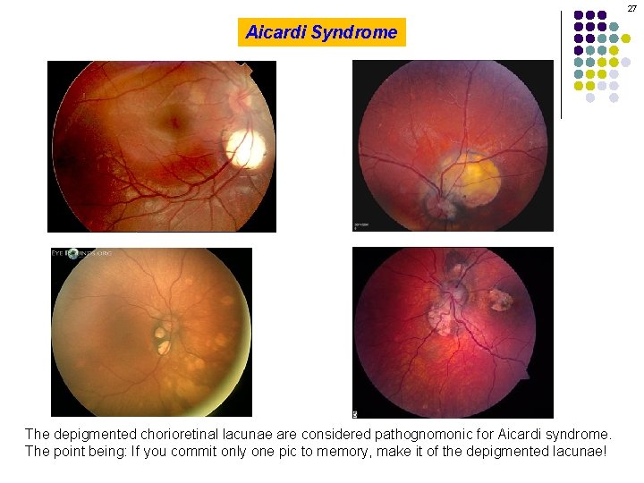 27 Aicardi Syndrome The depigmented chorioretinal lacunae are considered pathognomonic for Aicardi syndrome. The