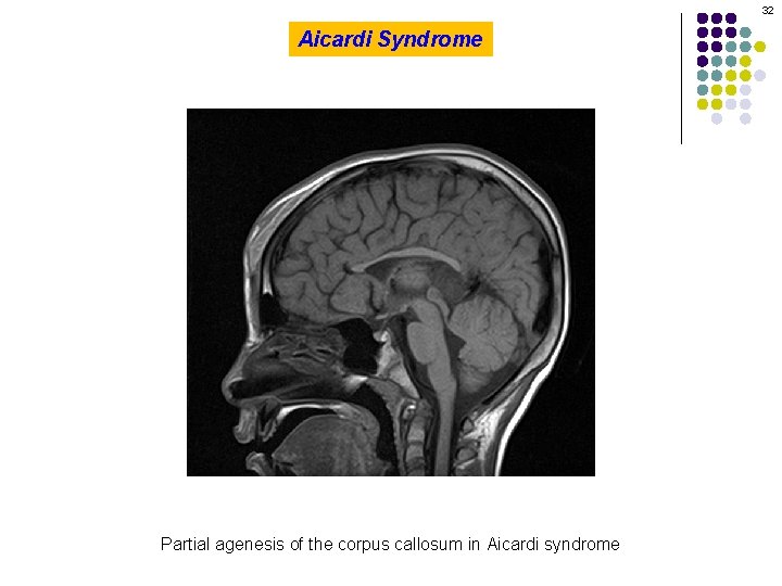 32 Aicardi Syndrome Partial agenesis of the corpus callosum in Aicardi syndrome 