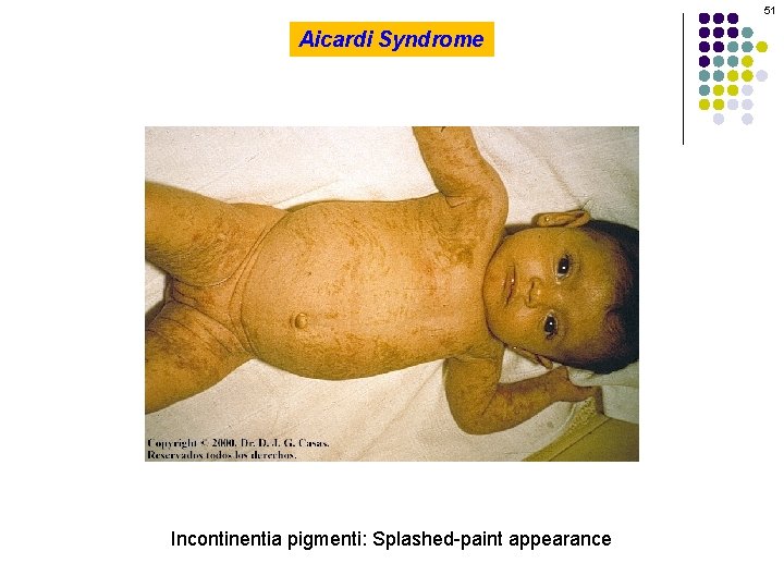 51 Aicardi Syndrome Incontinentia pigmenti: Splashed-paint appearance 