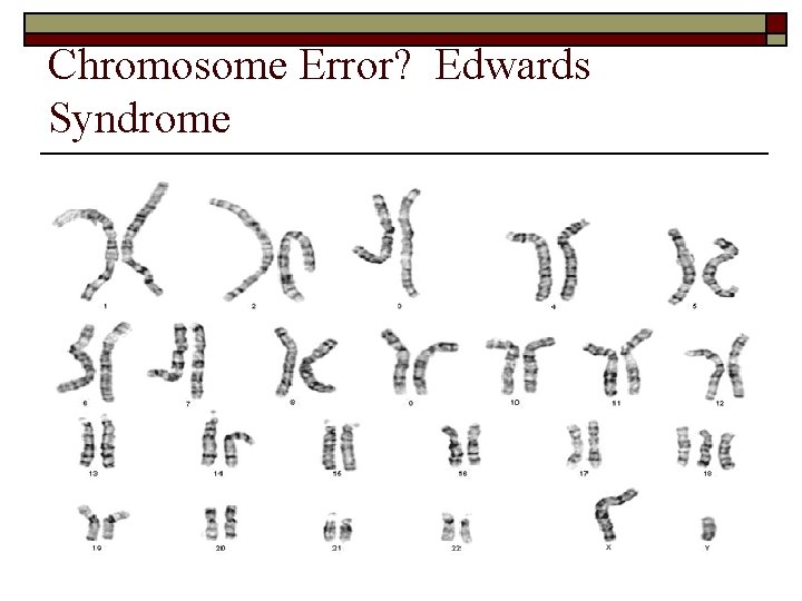 Chromosome Error? Edwards Syndrome 