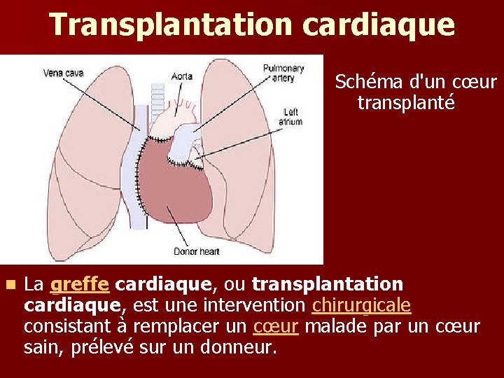 Transplantation cardiaque Schéma d'un cœur transplanté n La greffe cardiaque, ou transplantation cardiaque, est
