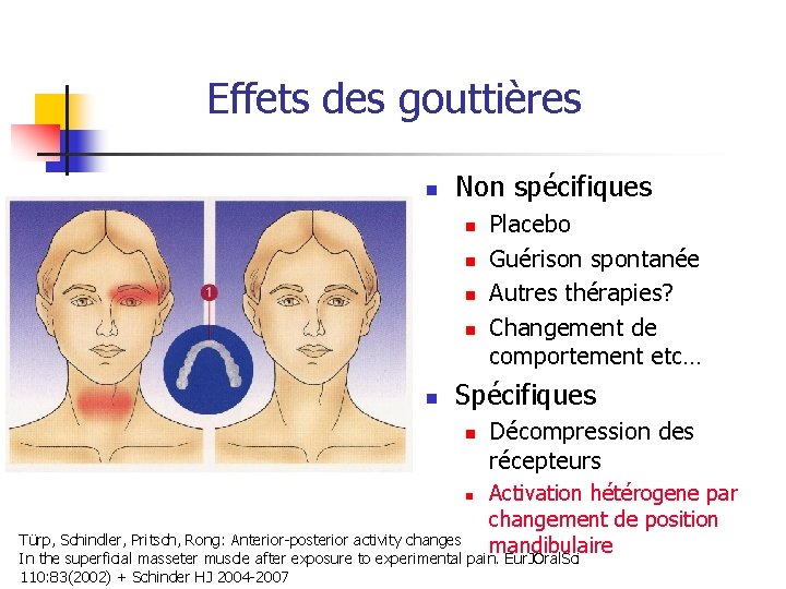 Effets des gouttières n Non spécifiques n n n Placebo Guérison spontanée Autres thérapies?