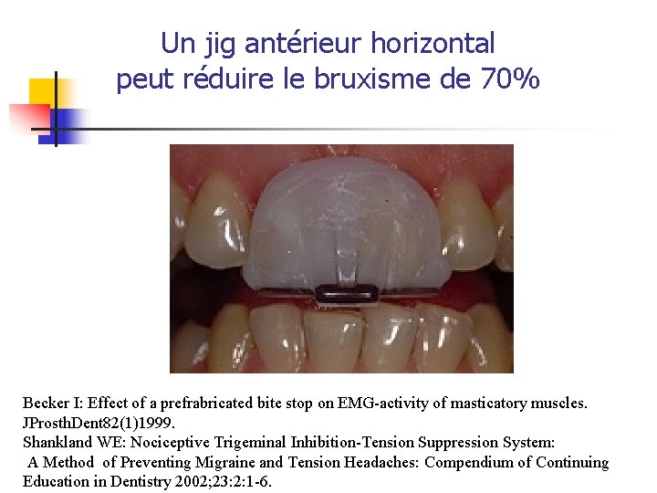 Un jig antérieur horizontal peut réduire le bruxisme de 70% Becker I: Effect of