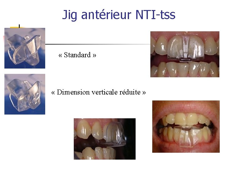 Jig antérieur NTI-tss « Standard » « Dimension verticale réduite » 