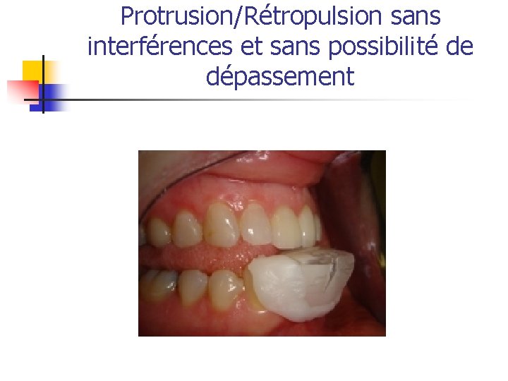 Protrusion/Rétropulsion sans interférences et sans possibilité de dépassement 