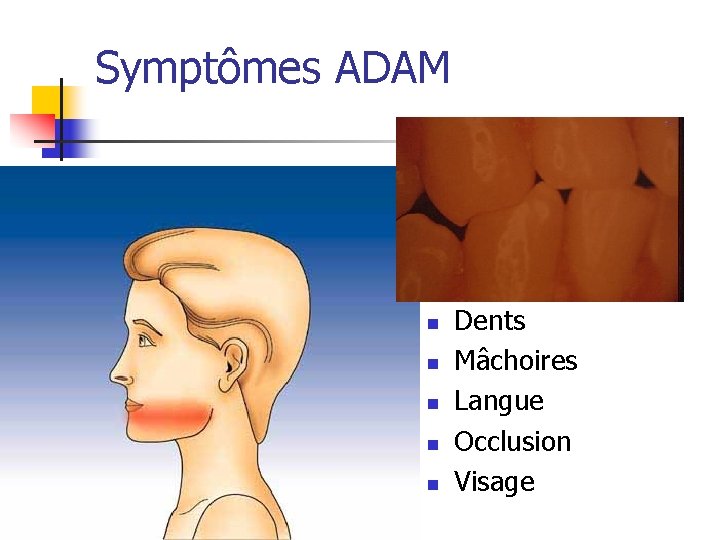 Symptômes ADAM n n n Dents Mâchoires Langue Occlusion Visage 