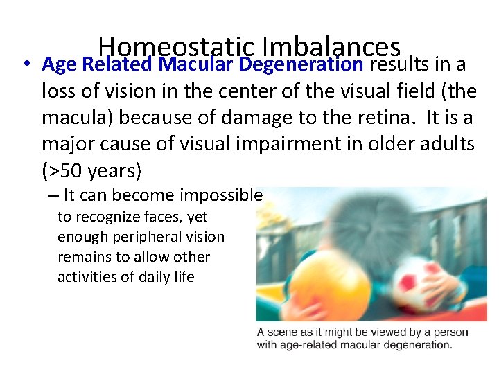  • Homeostatic Imbalances Age Related Macular Degeneration results in a loss of vision