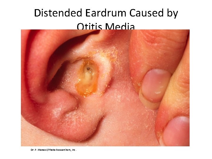Distended Eardrum Caused by Otitis Media Dr. P. Marazzi/Photo Researchers, Inc. 