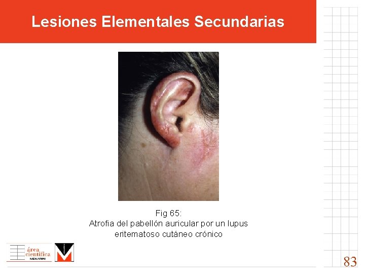 Lesiones Elementales Secundarias Fig 65: Atrofia del pabellón auricular por un lupus eritematoso cutáneo