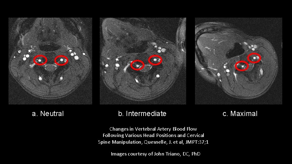 a. Neutral b. Intermediate Changes in Vertebral Artery Blood Flow Following Various Head Positions