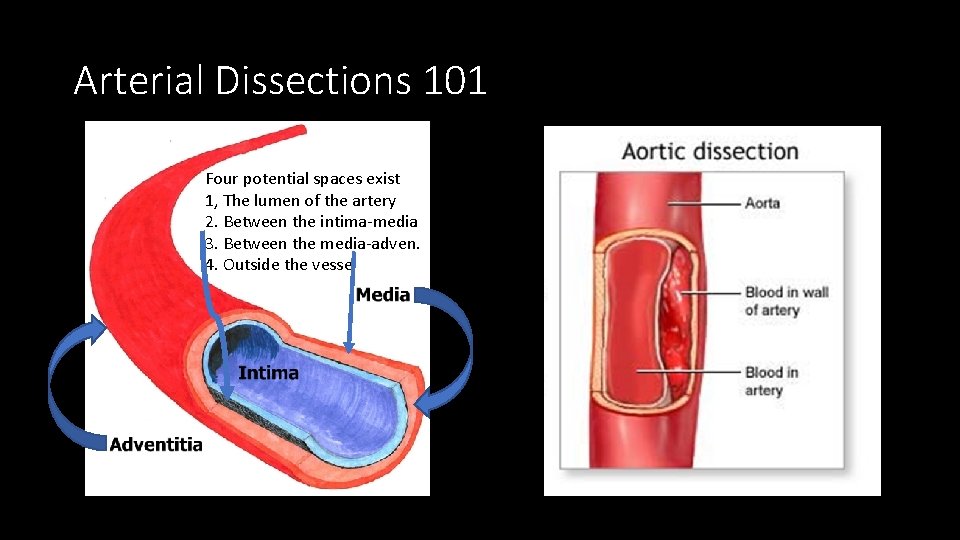 Arterial Dissections 101 Four potential spaces exist 1, The lumen of the artery 2.