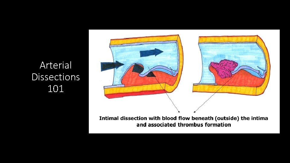 Arterial Dissections 101 