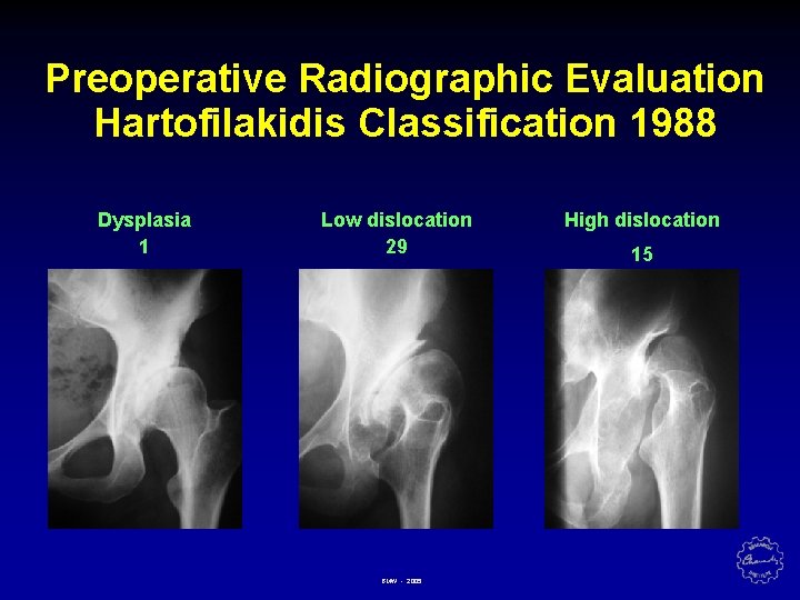 Preoperative Radiographic Evaluation Hartofilakidis Classification 1988 Dysplasia 1 Low dislocation 29 BMW - 2005