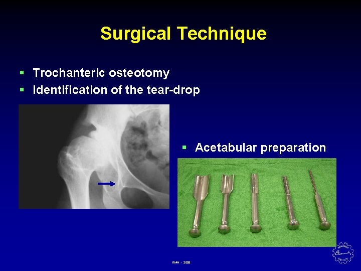 Surgical Technique § Trochanteric osteotomy § Identification of the tear-drop § Acetabular preparation BMW