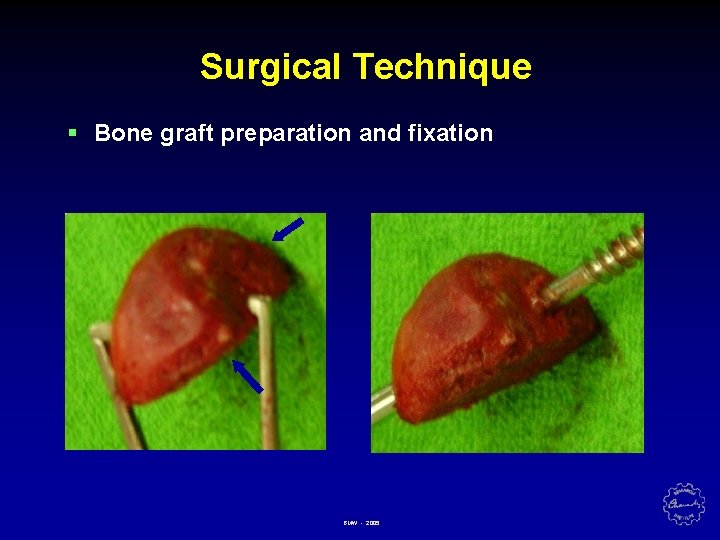 Surgical Technique § Bone graft preparation and fixation BMW - 2005 