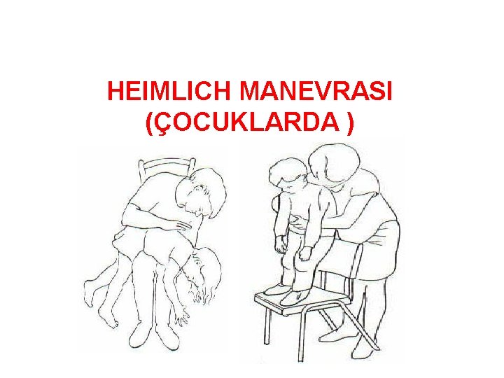 HEIMLICH MANEVRASI (ÇOCUKLARDA ) 