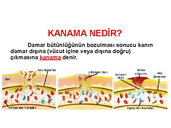 KANAMA NEDİR? Damar bütünlüğünün bozulması sonucu kanın damar dışına (vücut içine veya dışına doğru)