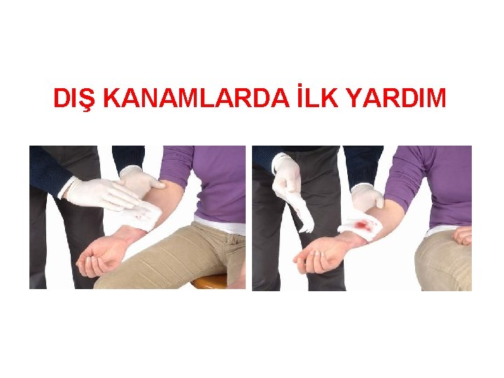 DIŞ KANAMLARDA İLK YARDIM 