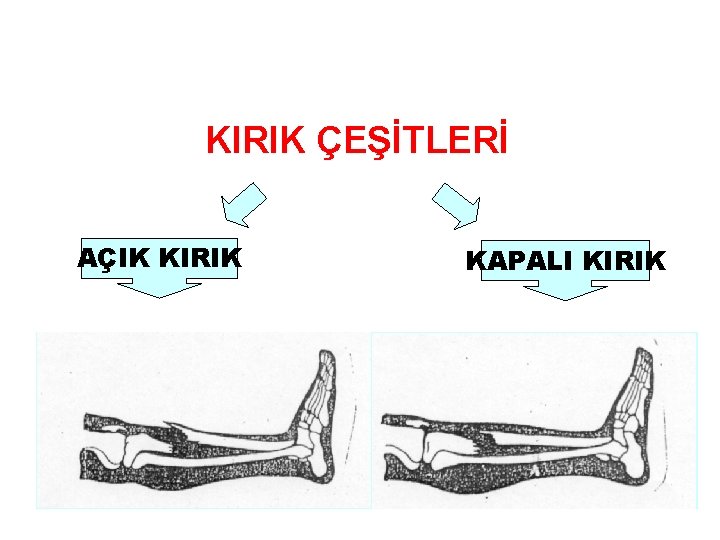 KIRIK ÇEŞİTLERİ AÇIK KIRIK KAPALI KIRIK 