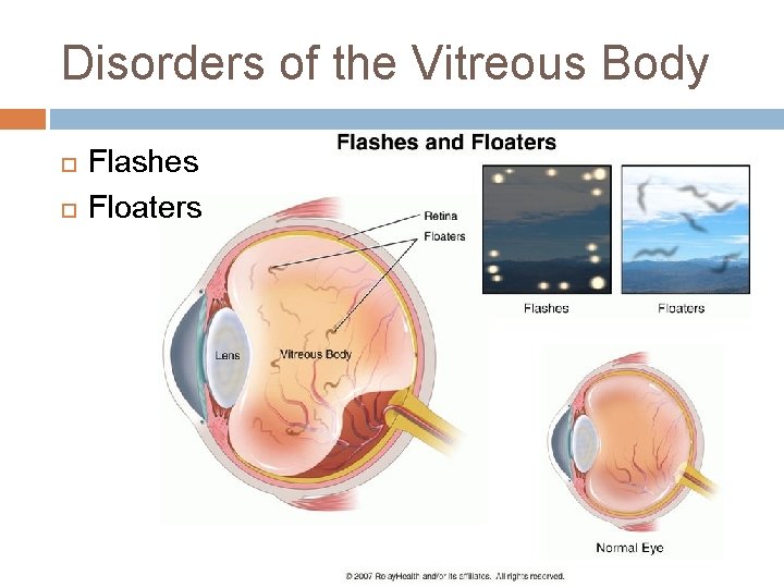 Disorders of the Vitreous Body Flashes Floaters Disorders of the Vitreous Body Flashes Floaters