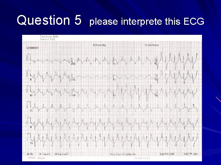 Question 5 please interprete this ECG 