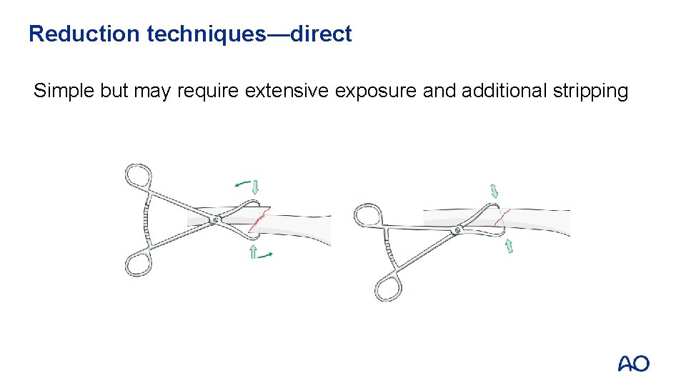 Reduction techniques—direct Simple but may require extensive exposure and additional stripping 