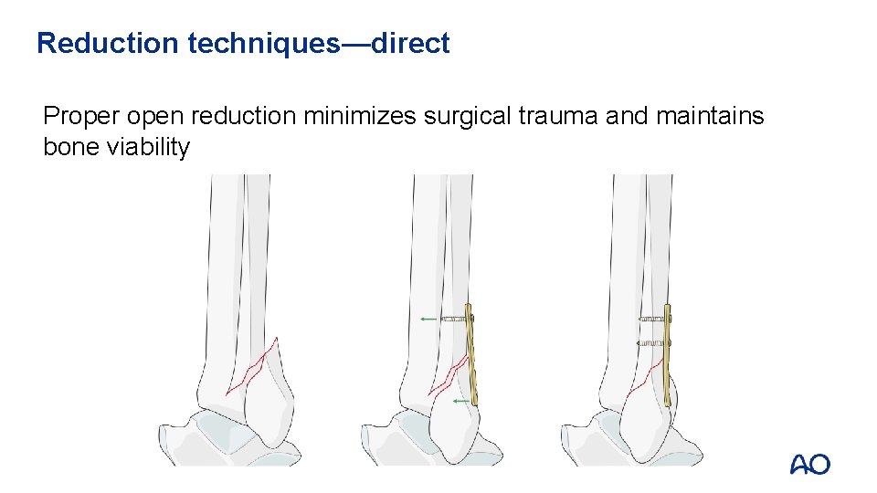 Reduction techniques—direct Proper open reduction minimizes surgical trauma and maintains bone viability 