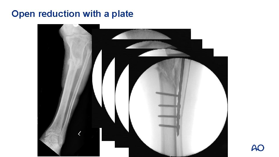 Open reduction with a plate 