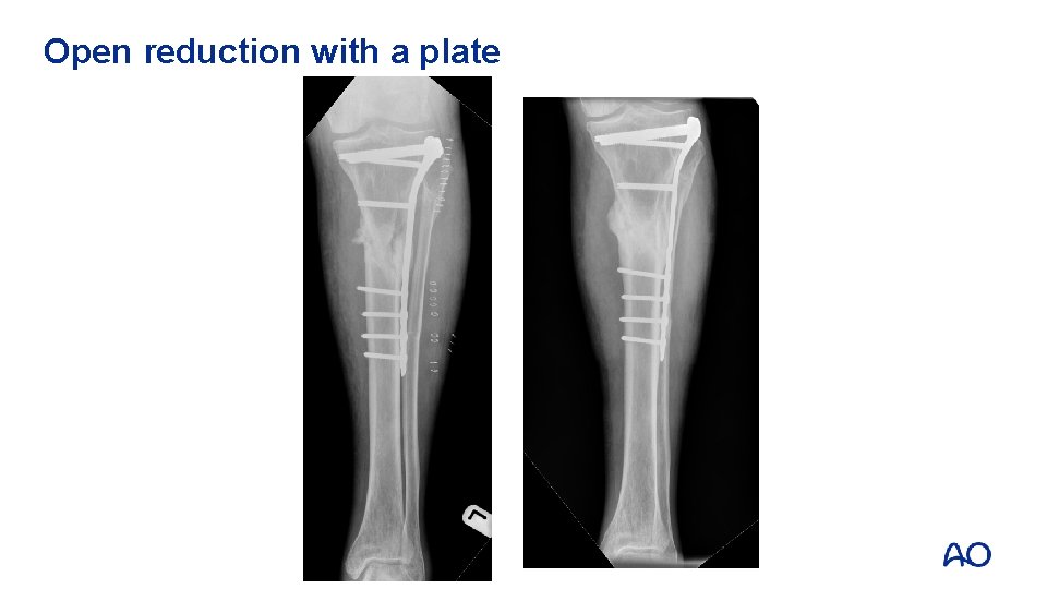 Open reduction with a plate 