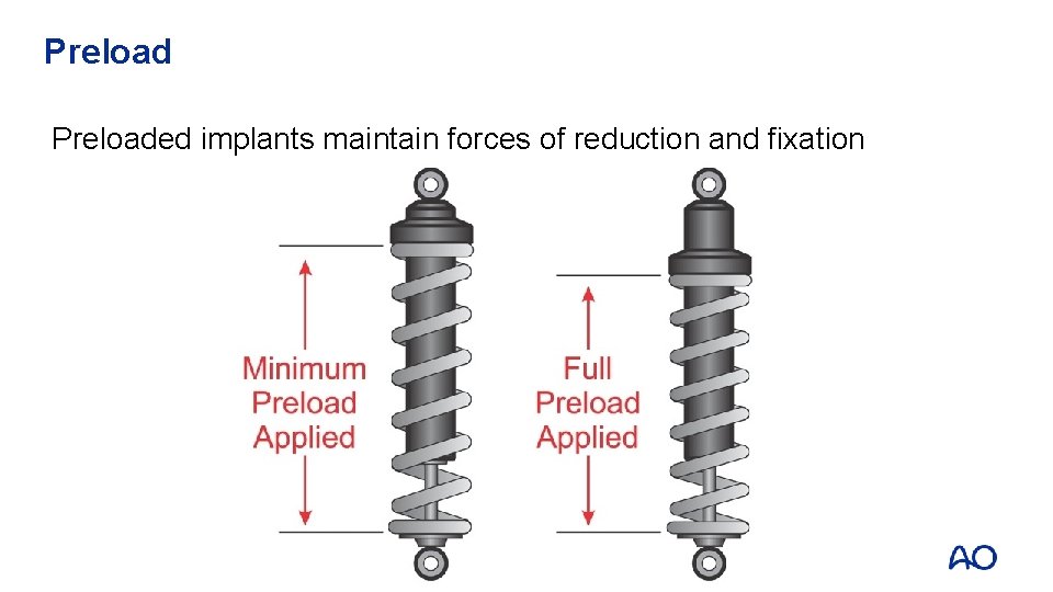 Preloaded implants maintain forces of reduction and fixation 