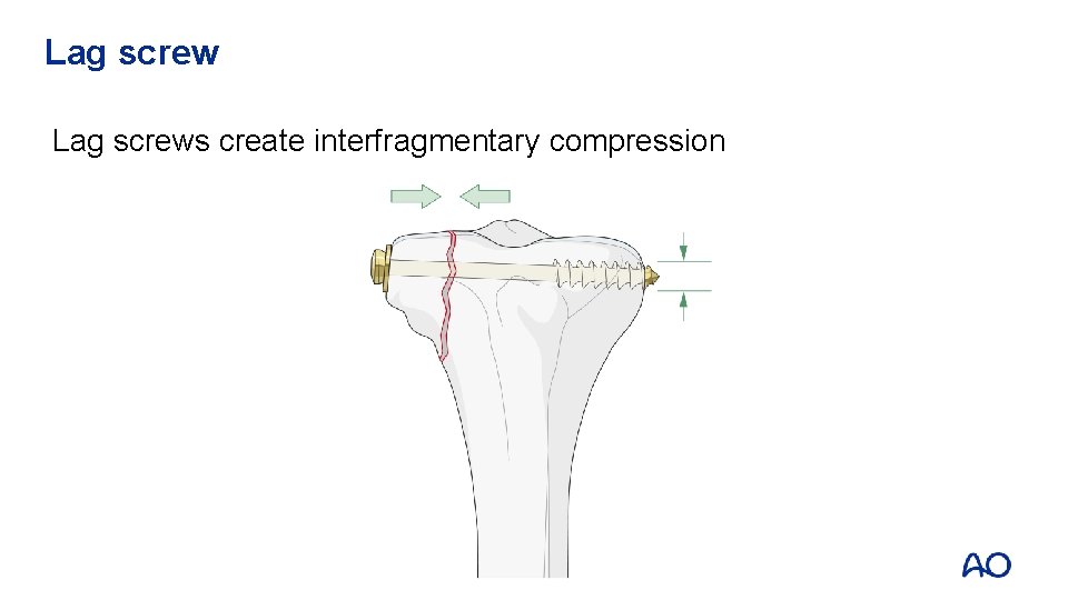 Lag screws create interfragmentary compression 