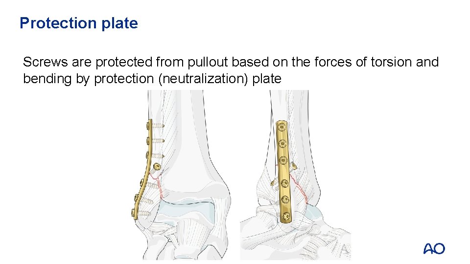 Protection plate Screws are protected from pullout based on the forces of torsion and