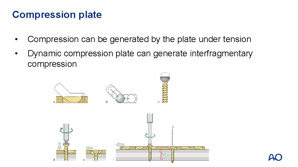Compression plate • Compression can be generated by the plate under tension • Dynamic